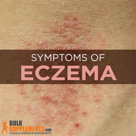 Eczema: Characteristics, Causes & Treatment