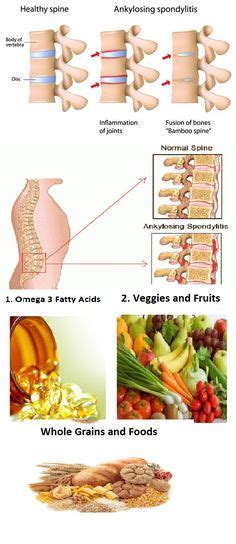 Ankylosing Spondylitis Diet – Everything You Need To Know Arthritis ...