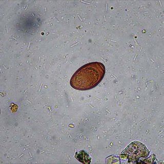 (PDF) Human infection with Dicrocoelium dendriticum in Turkey