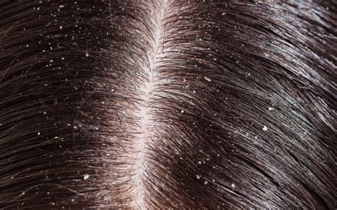 Dandruff Vs. Dry Scalp: What Are The Differences? – DifferenceCamp