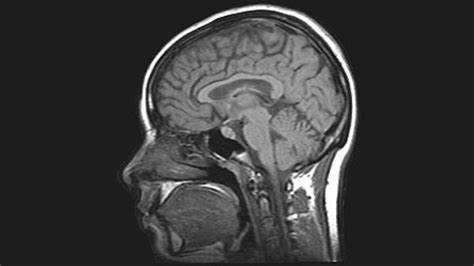 Brain Image Mri