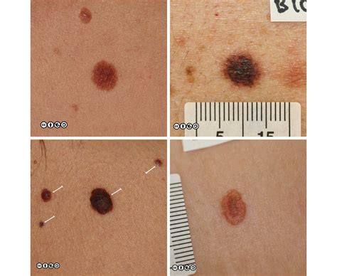 Melanoma images early stages, melanoma pictures early stages, early ...