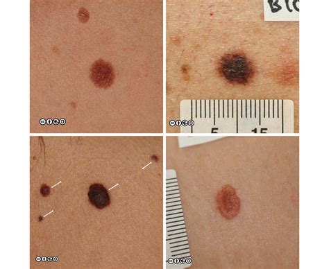 Melanoma Skin Cancer Stages