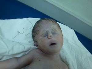 Patau Syndrome - Causes, Symptoms, Treatment, Prognosis and Pictures