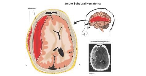 Subdural Hematoma | Top Neuro Docs