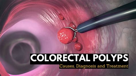 Colorectal Polyps, Causes, Signs and Symptoms, Diagnosis and Treatment. - YouTube