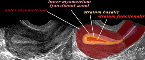 Ultrasound of the Uterus Showing Normal Endometrium and Myometrium - ART IN ANATOMY