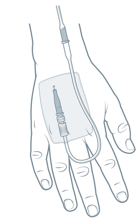 Nursing guidelines : Peripheral intravenous (IV) device management