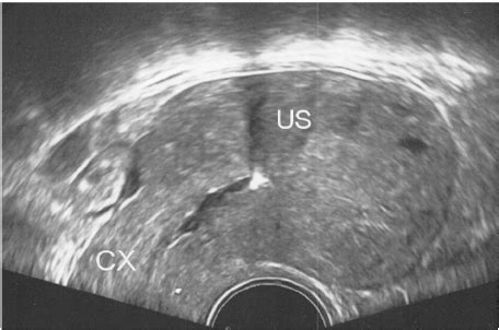 Transvaginal sonohysterographic evaluation shows the uterine synechiae.... | Download Scientific ...