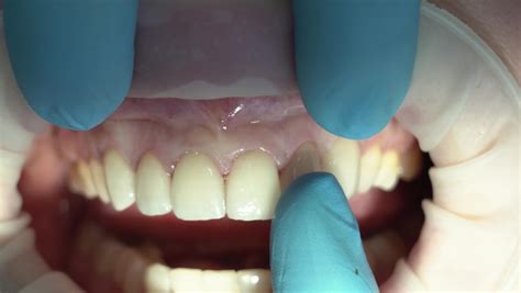 303 Dental fittings Stock Video Footage - 4K and HD Video Clips | Shutterstock