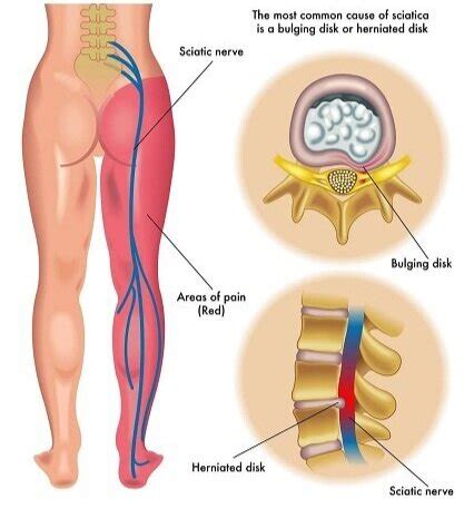 Essentials of a Disc Herniation & Bulging Discs | Physiotherapists in ...