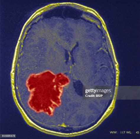 1,165 Brain Tumor Diagnosis Stock Photos, High-Res Pictures, and Images ...