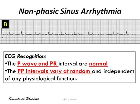 Sinus Arrhythmia