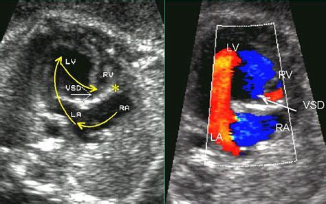 Color Doppler Sonography in assessment of the fetal heart | Ultrasound, Heart, Assessment