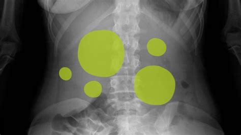 Gas in stomach: Symptoms, causes, and treatments