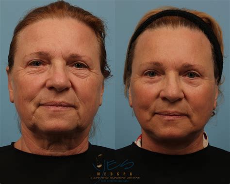 Lower Eyelid Blepharoplasty Before & After Photo Gallery | Vancouver, BC | YES Medspa & Cosmetic ...