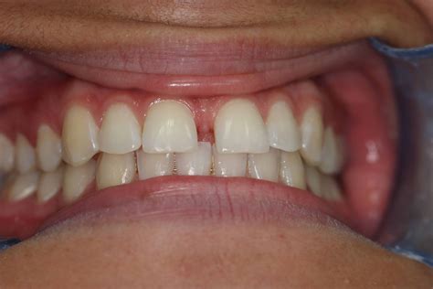 Diastema Gap Tooth Brisbane Orthodontics Before and After - Southside Dental Group