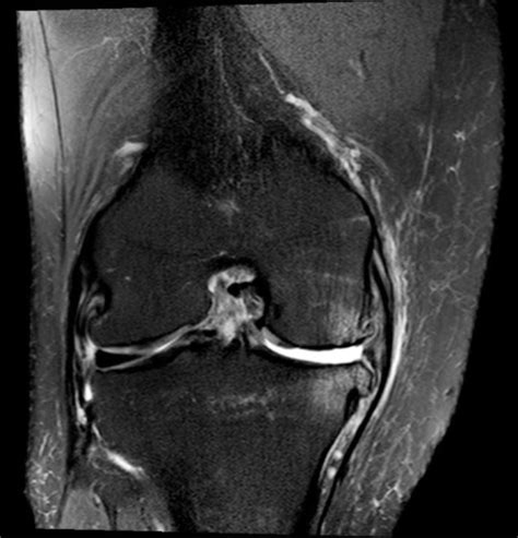 Coronal T2 weighted MRI image of a knee with a chronicA | OPENi