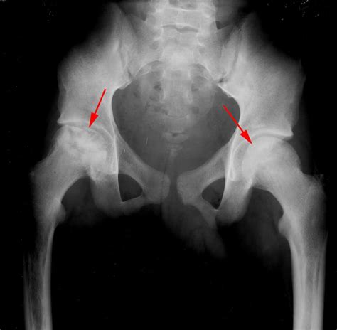 Avascular Necrosis Stages