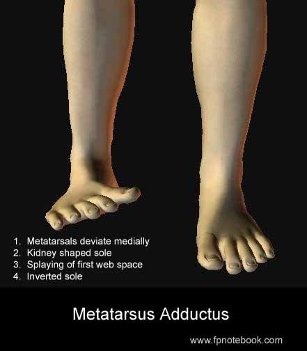 metatarsus adductus - USA News Collections