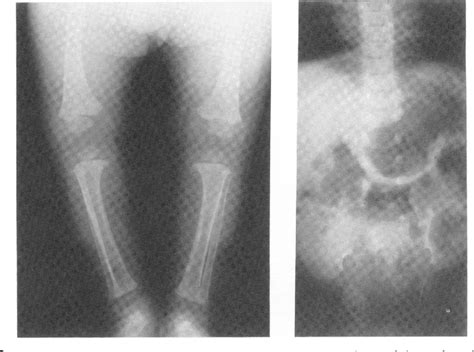 Spondyloepiphyseal dysplasia, congenita | Semantic Scholar