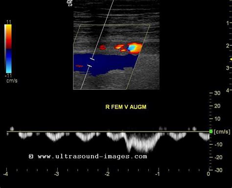 cochinblogs: Ultrasound imaging of popliteal vein thrombosis