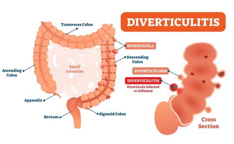 Vasa Recta Diverticulosis