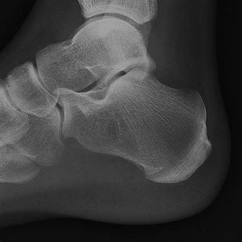 Foot Injuries - RCEMLearning