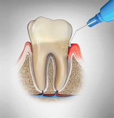 Oraqix – Dentistry.com