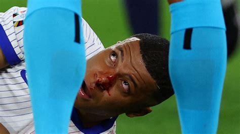 Euro 2024: France captain Kylian Mbappe suffers broken nose during ...