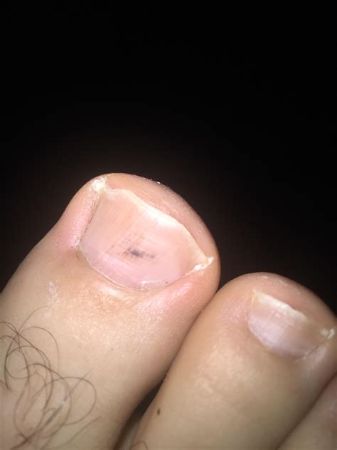 Black under toenail - should I be worried? : r/Melanoma