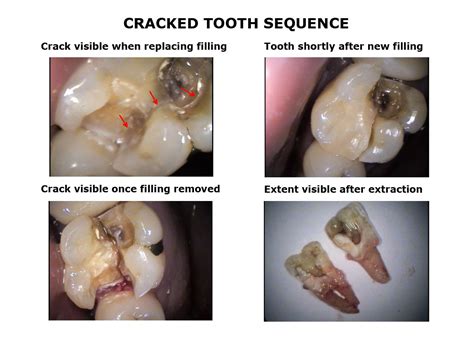 Cracked Teeth Treatment | My Family Dentist