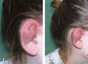 Cartilage (Ear) Piercing Information - Procedure, Healing & Infection Risks