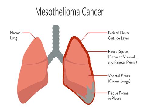 Mesothelioma Symptoms, Diagnosis, and Treatment