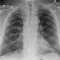 Acute Eosinophilic Pneumonia Secondary to Daptomycin – Critical Care ...