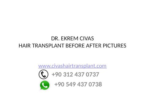 (PPTX) Dr. Ekrem Civas hair transplant before after pictures - DOKUMEN.TIPS