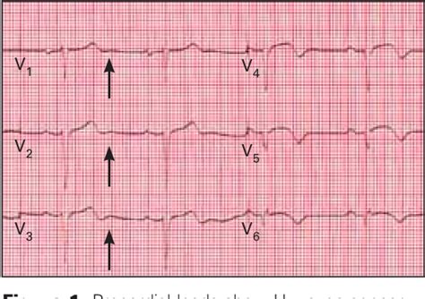 Figure 1 from The Mysterious U Wave. | Semantic Scholar