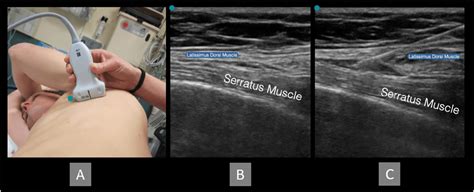 Serratus anterior plan block. (A) Patient and transducer positioning.... | Download Scientific ...