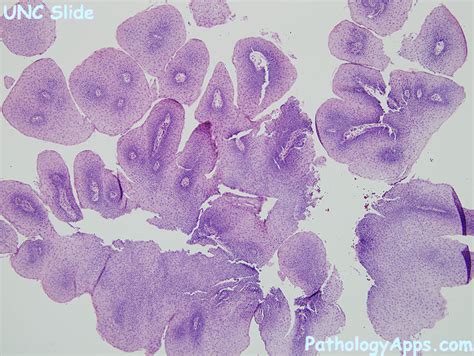 squamous papilloma larynx histology