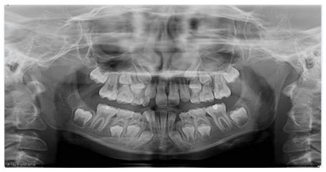 Uncovering a Mesiodens with 3D Visualization | RxSmile Frisco Orthodontist | Frisco Invisalign