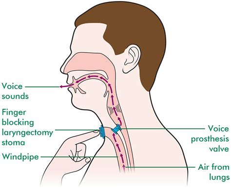 Laryngectomy stoma - Macmillan Cancer Support