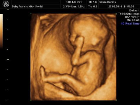 Pin on Ultrasound Scan Images