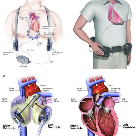 Classification of mechanical circulatory support devices. BiVAD ...