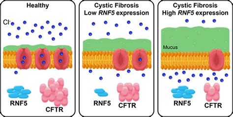 Modifier gene may explain why some with cystic fibrosis are less prone ...