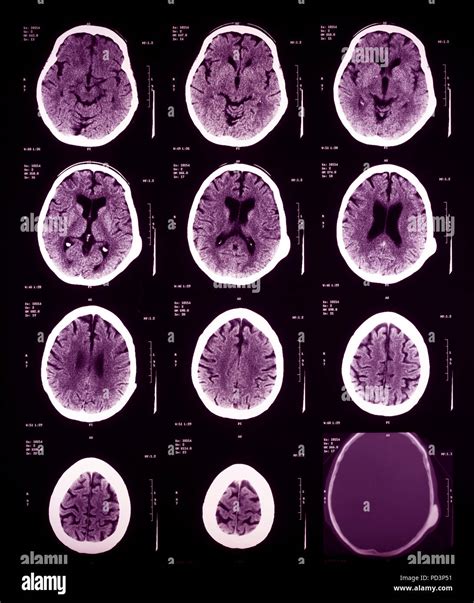 Sequence of horizontal sections of a female human brain, MRI scans ...