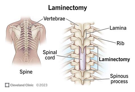 Laminectomy: What It Is, Procedure, Recovery & Complications