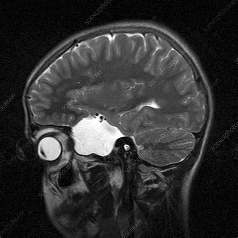 Arachnoid Cyst, MRI scan - Stock Image - M130/0945 - Science Photo Library