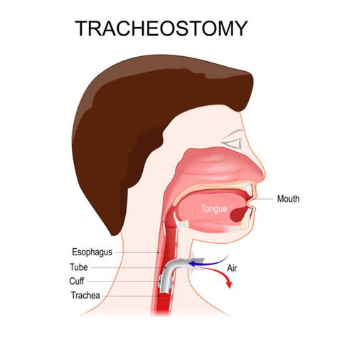 Tracheostomy Cuff Illustrations, Royalty-Free Vector Graphics & Clip ...