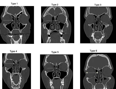 Anatomical Variants of the Uncinate Process: A Challenge in the ...