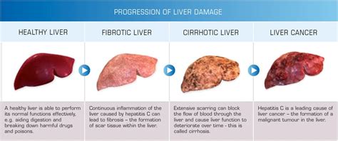 Whose liver is at Greater Risk? The Obese’s or the Binge-Drinker’s | SiOWfa15: Science in Our ...